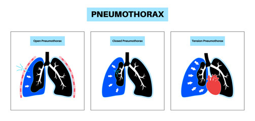 Wall Mural - Pneumothorax anatomical poster