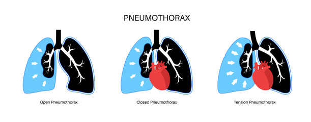 Canvas Print - Pneumothorax anatomical poster