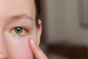 Poster - Woman with yellow eyes on blurred background, closeup. Symptom of hepatitis