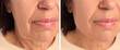 Mature woman before and after skin tightening treatments. Collage with photos, closeup
