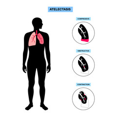 Poster - Atelectasis medical poster