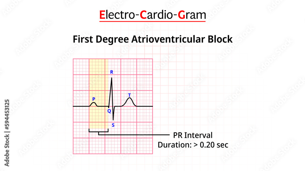 First Degree Atrioventricular Block - AV Block -Electrocardiogram ...