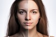 Before and after portrait of a woman's face with pimples and after beauty treatment. Ai generated.