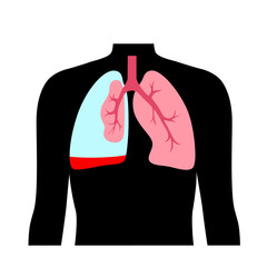 Poster - Hemopneumothorax medical poster