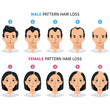 Hair loss stages, androgenetic alopecia male and female pattern. Steps of baldness vector infographic in a flat style with a man and a woman png