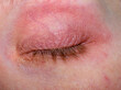 Zamknięte spuchnięte i zaczerwienione powieki z alergią z bliska
