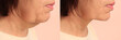 Double chin problem. Collage with photos of mature woman before and after skin tightening treatments on beige background, closeup