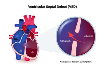 Wall Mural - Ventricular septal defect vector. Congenital heart defect.