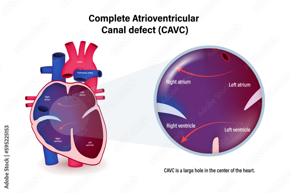 Complete Atrioventricular Canal defect (CAVC) vector. Congenital heart ...