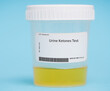 Urine ketones test