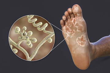 Wall Mural - The foot with mycosis, and close-up view of fungi that cause Athlete's foot, 3d illustration