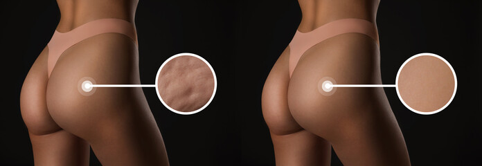 Sticker - Before and after cellulite treatment, zoomed smooth and dimpled skin. Collage with photos of slim woman in underwear on black background, closeup