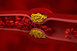 Partly blocked vessel in high level of LDL (bad cholesterol) lipoprotein – isometric view 3d illustration