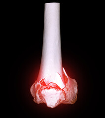 Poster - CT scan of knee joint 3D rendering image  showing fracture of distal femur bone.