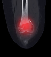 Poster - CT scan of knee joint   showing fracture of distal femur bone.
