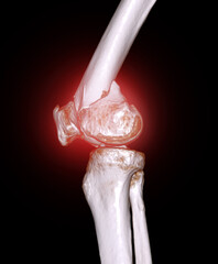 Poster - CT scan of knee joint 3D rendering image  showing fracture of distal femur bone.