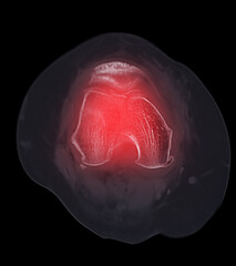 Poster - CT scan of knee joint   showing fracture of distal femur bone.