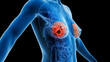 © Sebastian Kaulitzki - 3d rendered medical illustration of breast cancer
