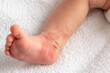 Hemangioma red birthmark on the leg of newborn baby