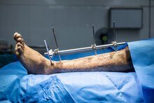 The External Fixator In Orthopedic Patient After Car Accident.External Fixation With Blur Background Inside Operating Room.Blue Drape.Fracture Left Leg After Trauma.Severe Injury With Damage Control.