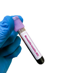 Poster - Microsatellite Instability (MSI) test,MSI screening is used to see the function of Lynch syndrome genes, Hereditary Colorectal Cancer. DNA mismatch repair.