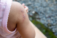 Impetigo On A Child's Shoulder Caused By Streptococcus And Staphylococcus Bacteria