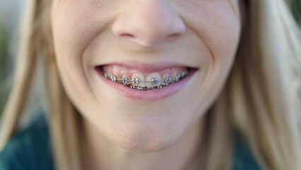 Wall Mural - Young blonde woman smiling confident showing braces at street