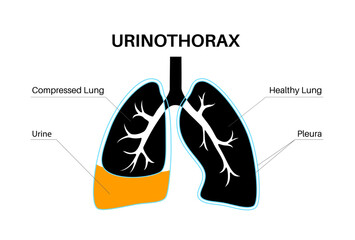 Wall Mural - Urinothorax anatomical poster