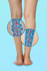 Sticker - Closeup view of woman with varicose veins on light blue background. Illustrations of damaged and healthy vein on white background, longitudinal section