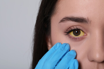 Poster - Doctor checking woman with yellow eyes on light background, closeup. Symptom of hepatitis