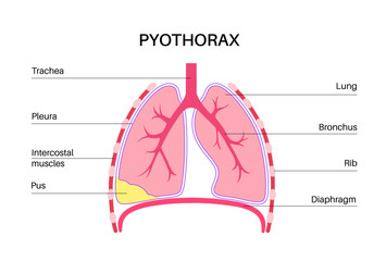 Canvas Print - Pyothorax pleural empyema