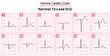 The Differences in Normal ECG Waveform for Each of the 12 Leads Standard ECG - Medical Vectors and Illustrations for Medical Purposes