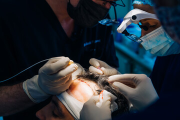 Wall Mural - a team of doctors performs a hair transplant operation on a man. hair loss problem.