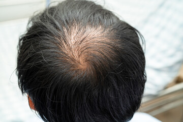 Bald in the middle head and begin no loss hair glabrous of mature Asian business smart active office man.