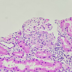 Wall Mural - Cameras photo of segmental endocapillary hypercellularity in case of lupus nephritis, magnification 400x, photograph through a microscope