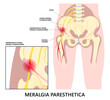 Hip sciatica bursitis pain Leg Injury and IT Band Syndrome or Meralgia Paresthetica compressed spine tingling numbness thigh pinched nerve