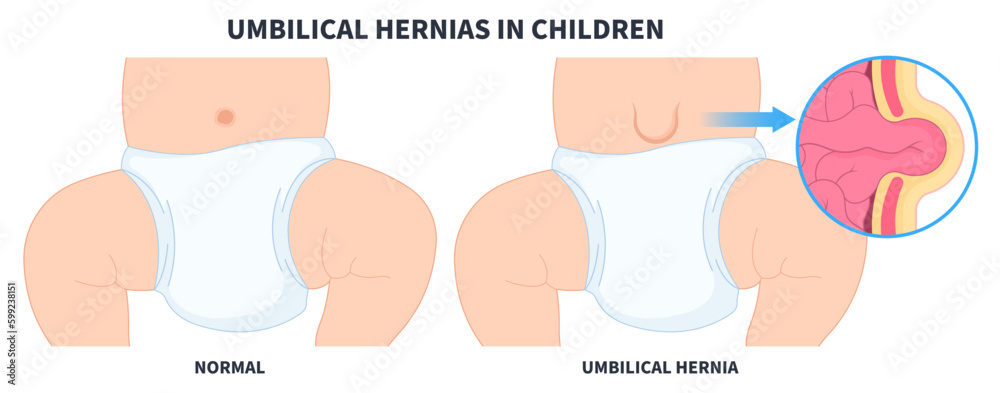 baby infant umbilical hernia of inguinal incisional Femoral stomach ...