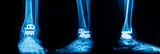Blue radiograph on black background in hospital.Doctor used xray for diagnosis of patient.X-ray of total ankle joint arthroplasty with prosthesis.Orthopedic and radiology technology.Medical concept.