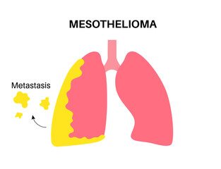 Canvas Print - Mesothelioma cancer disease