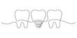 © Iuliia - Teeth row with healthy and implant tooth, continuous art line drawing. Dentistry health. Vector hand drawn