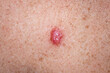 © ArboursAbroad.com - Young female 30s close up of chest prior to applying imiquimod cream medication to basal cell carcinoma.