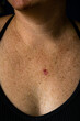 Vertical view of ulcerated sore superficial basal cell carcinoma red discoloration on young 30s caucasian female chest.