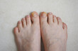 © Viktoryia - Toenails affected by fungal infection. Onychomycosis