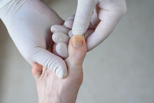 Onychomycosis. Foots With Fungus On Nails Is Examined By Doctor In Gloves