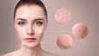 Magnifying circles demonstrate couperose and acne on face skin.