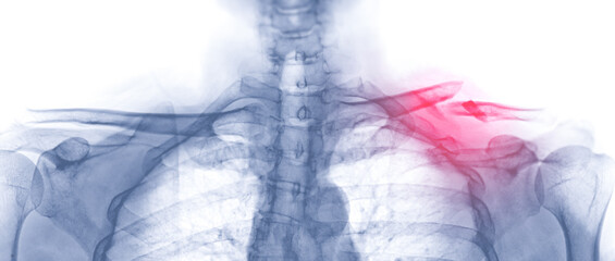 Poster - X-ray of Clavicle AP view showing fracture of left Clavicle bone.