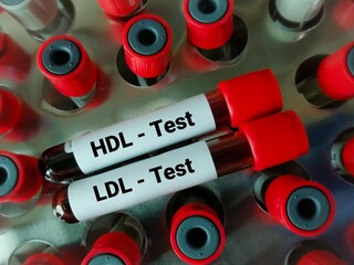 Sticker - Blood samples isolated for HDL Cholesterol (good cholesterol) and LDL Cholesterol (bad cholesterol) test, Cardiovascular disease diagnosis.