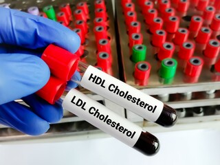 Sticker - Blood samples for HDL Cholesterol (good cholesterol) and LDL Cholesterol (bad cholesterol) test, Cardiovascular disease diagnosis.