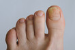 © Viktoryia - Toenails affected by fungal infection. Onychomycosis