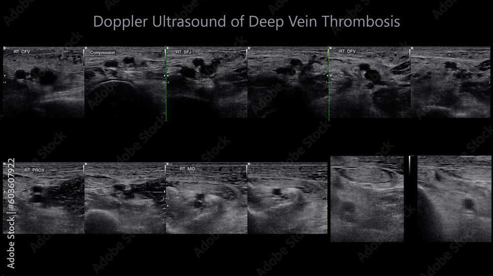 Color Doppler ultrasound determination in deep vein thrombosis patients ...